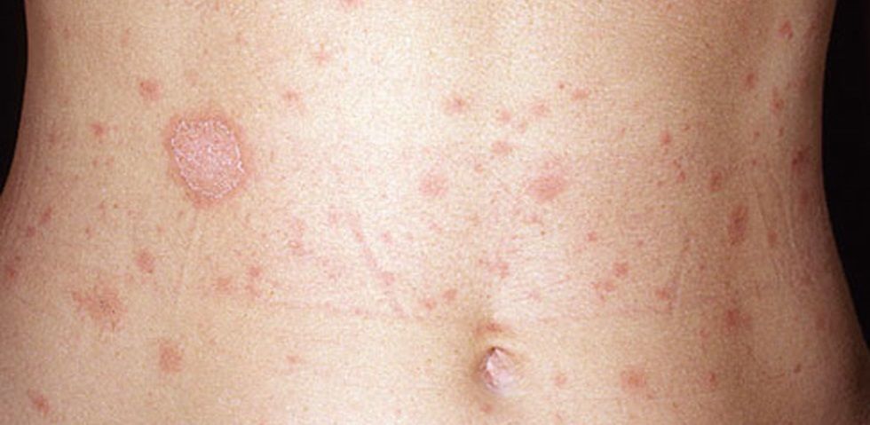 Diagnosis And Treatment Of Lichen Planus Dermatology Laser Surgery Cosmetology