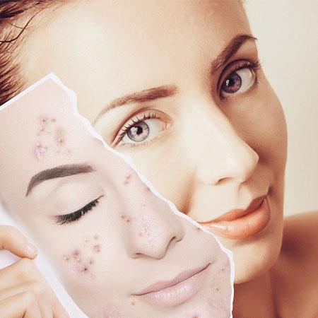 Modern methods of treatment of acne vulgaris in Tashkent in the clinic  &quot;Dermacenter&quot;. Dermatology | Laser Surgery | Laser | Laser Vaginoplasty |  Cosmetology.
