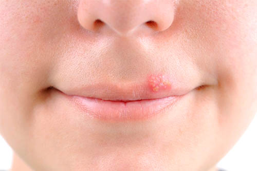 Treatment of herpes simplex in adults and children in Tashkent