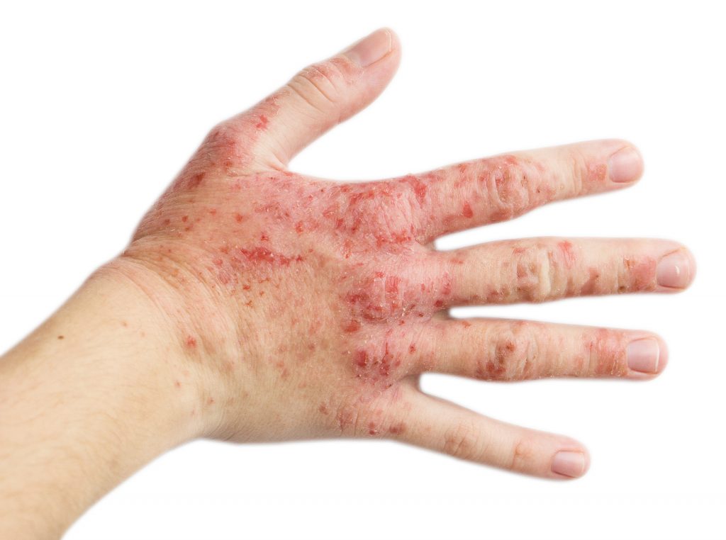 New treatment for psoriasis.