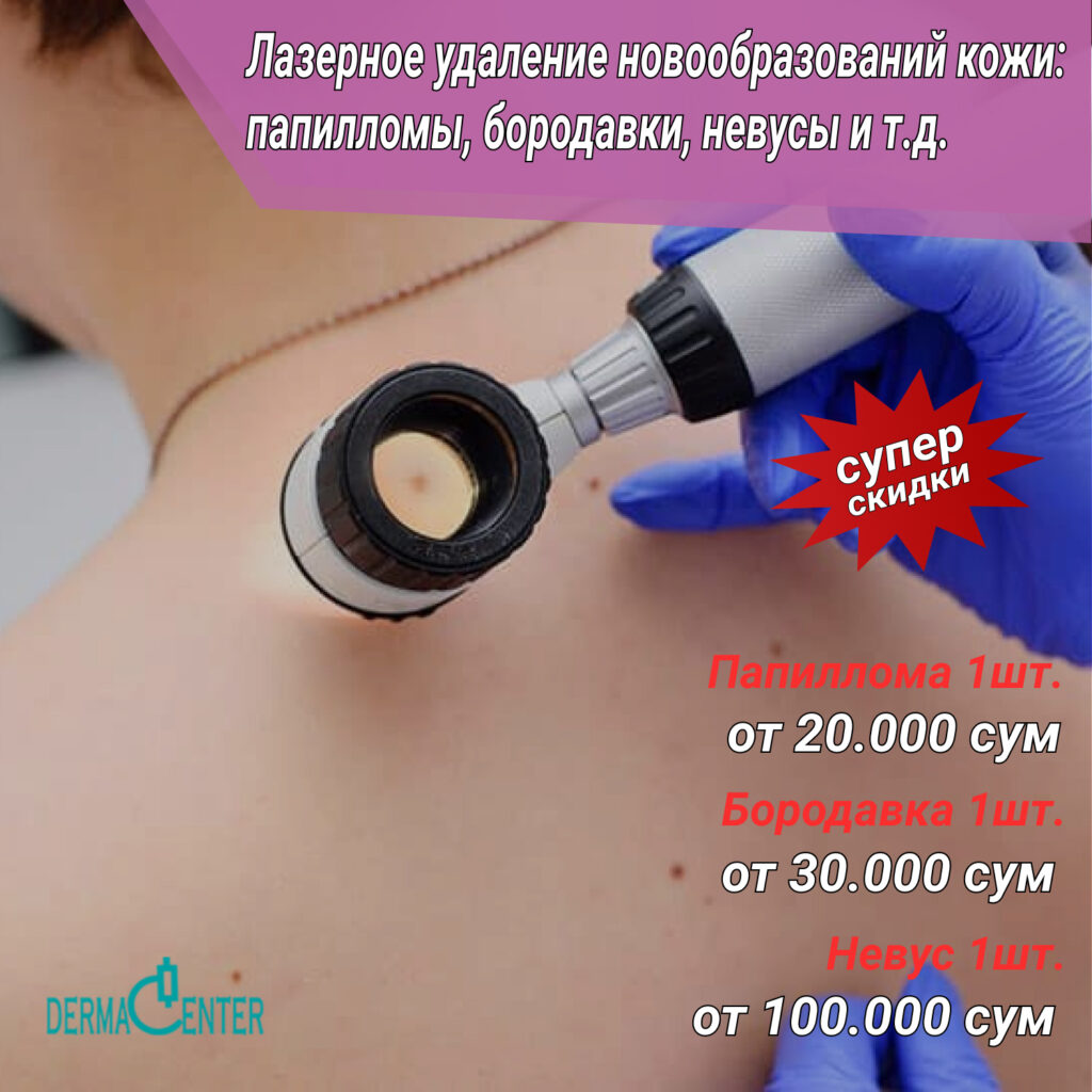 Лазерное удаление новообразований кожи в Ташкенте