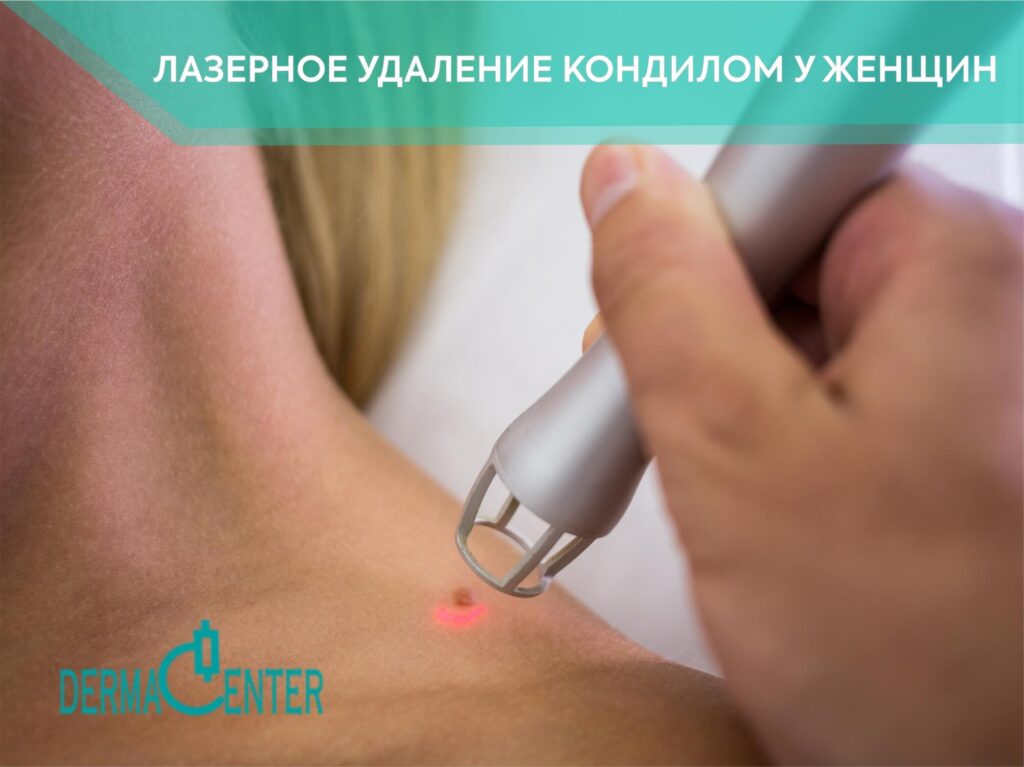 Лазерное удаление кондилом у женщин