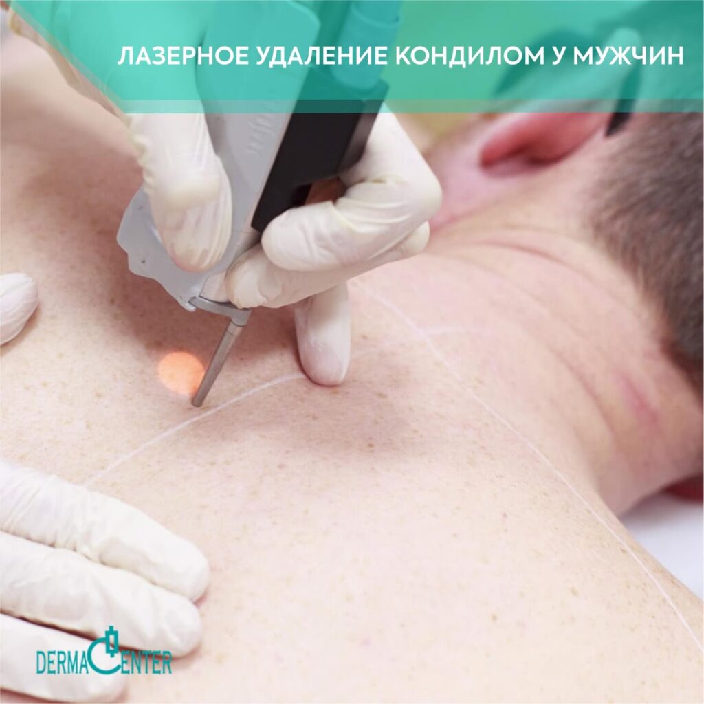 Лазерное удаление кондилом у мужчин в Ташкенте