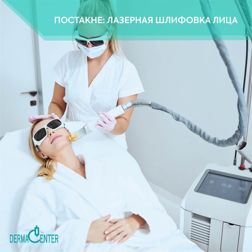 Постакне: Лазерная шлифовка в Ташкенте