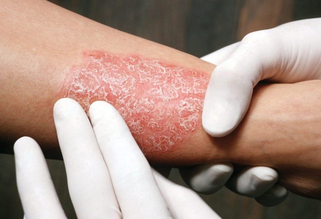 Toshkentda psoriazni davolash